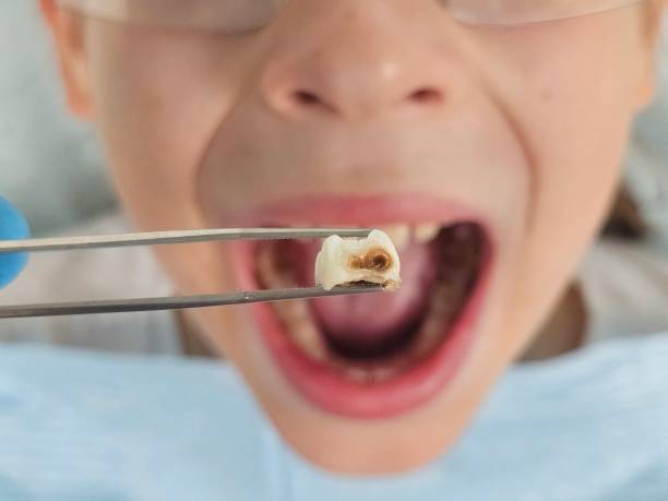 Best Chipped Tooth Repair Near Me  in North Terre Haute, IN
